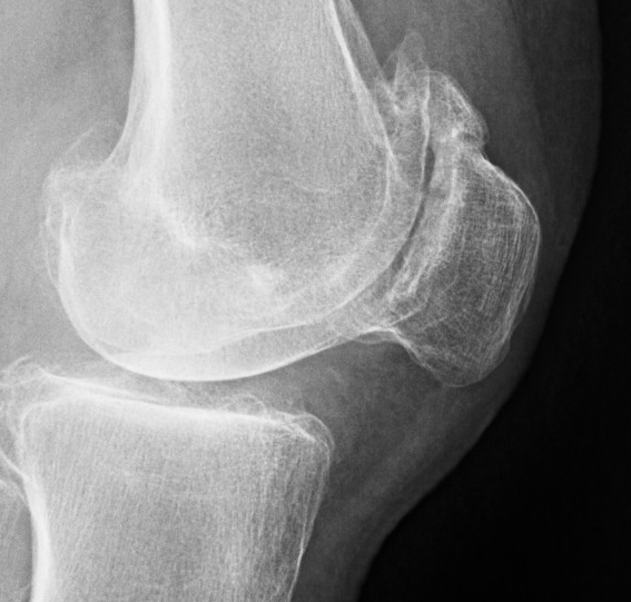 Patella OA Lateral